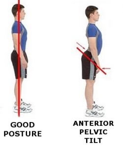 fix-anterior-pelvic-tilt-poor-posture-250x300.jpg